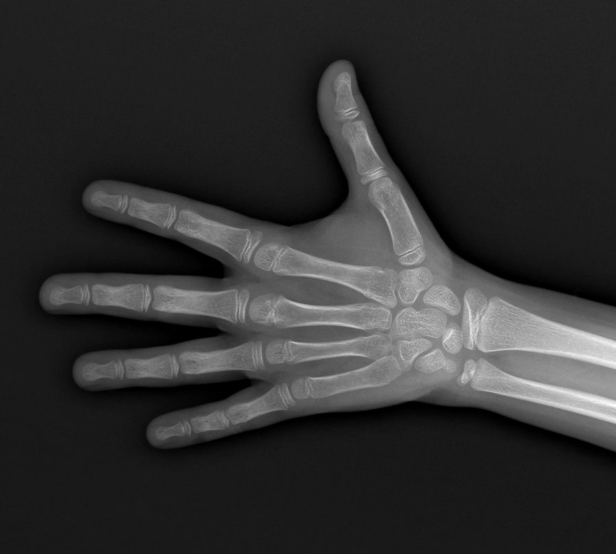 Sample paediatric hand-wrist radiograph